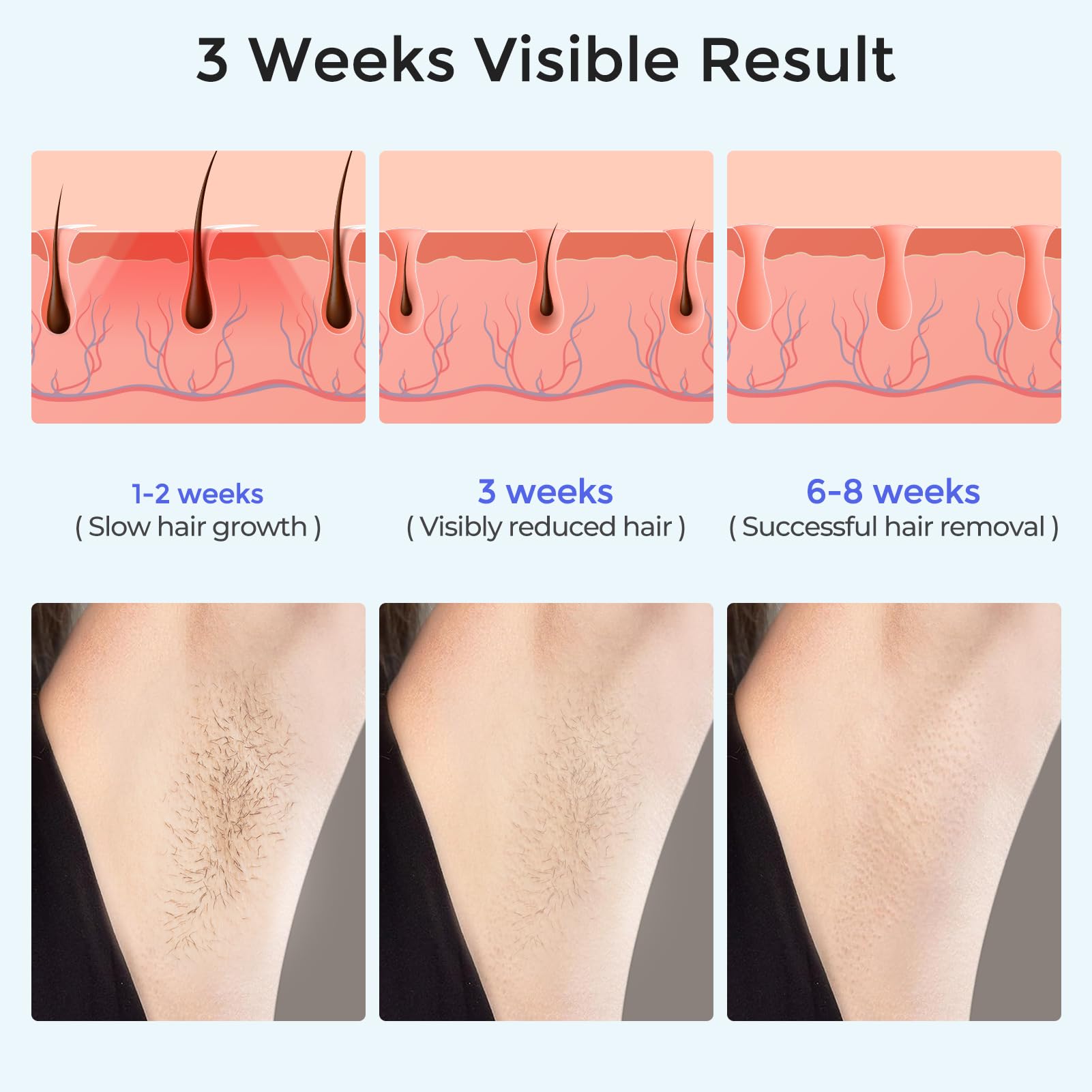LUBEX IPL Laser Hair Removal Device with Sapphire Ice-Cooling Technology - Painless & Permanent Hair Remover for Women & Men - At-Home Alternative to Salon Treatments - Full Body Use for Legs, Armpits, Bikini Area & Facial Hair - Perfect for Smooth Skin at Home, Travel & Pre-Beach Prep