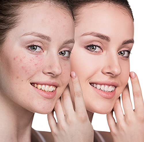 Khadi Rishikesh Herbal Neem Acne Pimple Face Pack - Reduces Dark Spots, Anti-Aging & Wrinkles with Calamine, Tulsi & Tree Turmeric | Suitable for All Skin Types | Men & Women - 50gm | Perfect for Daily Skincare Routine & Acne Treatment
