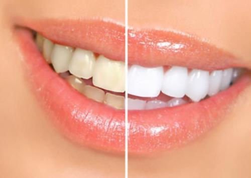 Professional 44% Carbamide Peroxide Teeth Whitening Kit with LED Light & Custom Trays - Effective Whitening Gel for Brighter Smile at Home or Travel