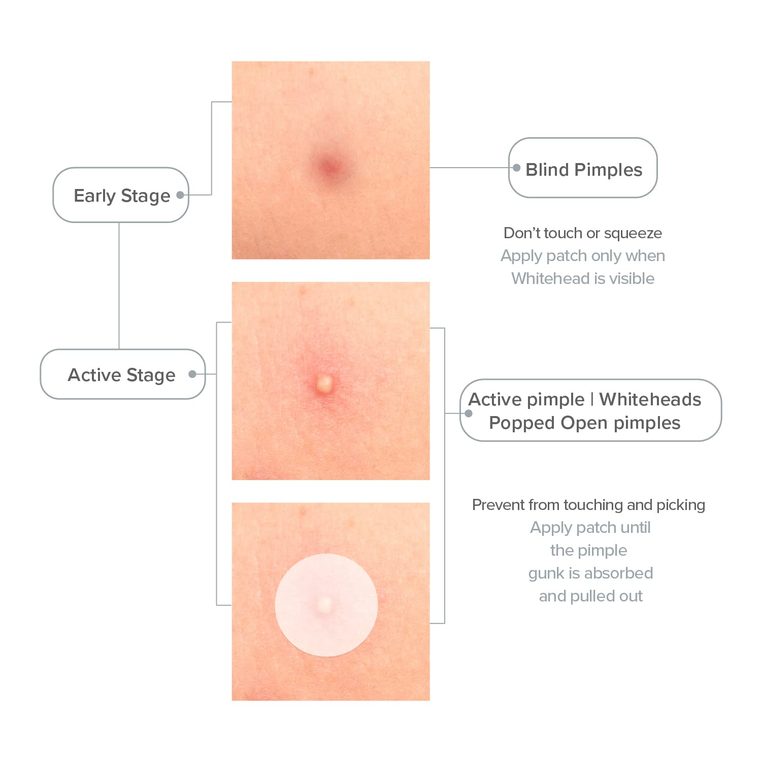 PRIVEDA Acne Pimple Patch - 57 Hydrocolloid Patches for Face (8mm/10mm/12mm) | Korean Made, Waterproof Spot Treatment for Overnight Healing | Perfect for Teen & Adult Acne, Whiteheads & Blackheads