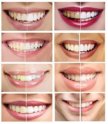 10 Syringes (3ml) 44% Carbamide Peroxide Teeth Whitening Gel - Professional Strength for Brighter Smile | At-Home & Dental Office Use
