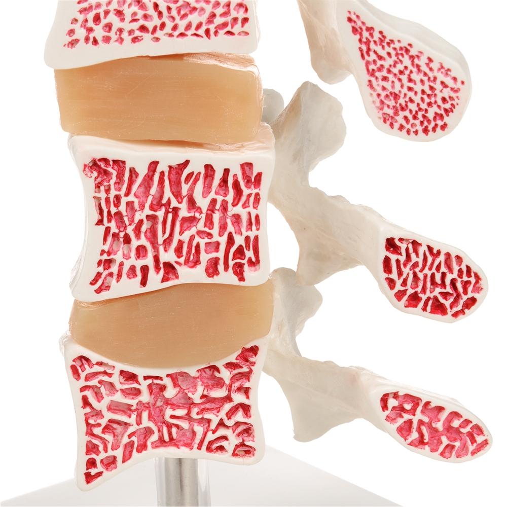 Premium Osteoporosis Bone Model - Anatomically Accurate Skeletal Display for Medical Education & Patient Demonstration - Perfect for Classrooms, Clinics, and Healthcare Training