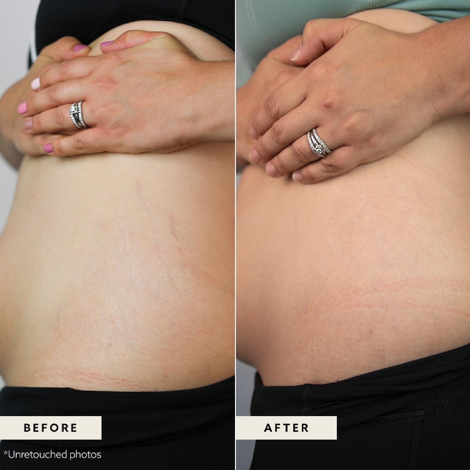 LUMA & LEAF Pregnancy Stretch Mark Cream - Organic Tasmanian Pepperberry Body Butter for Women - Hydrating Shea Butter Moisturizer - Belly Butter for Expecting Moms - Perfect for Pre & Post Pregnancy Care & Dry Skin Relief