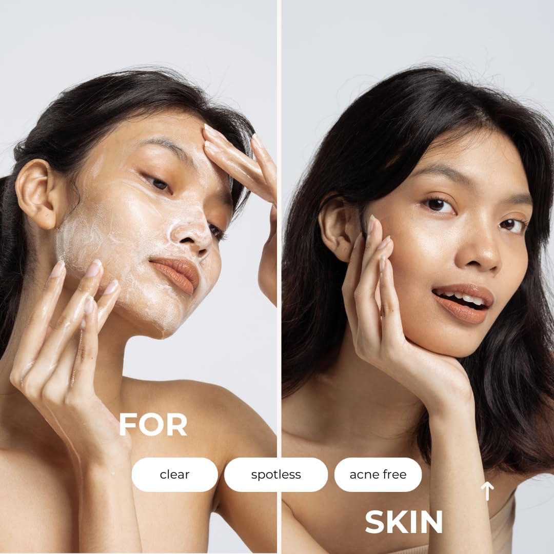 hollywoodskin INTENSE Acne Cream with 2% Salicylic Acid - Overnight Acne Treatment, 400% Stronger Than Regular Acne Creams - 50ml (4 Pack) for Clear Skin - Perfect for Nighttime Use on Face, Back & Body Breakouts