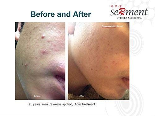 Serment Enzyme Acne Face Wash Powder - Hypoallergenic Cleanser for Sensitive Skin | Pore Purifying & Acne Prevention