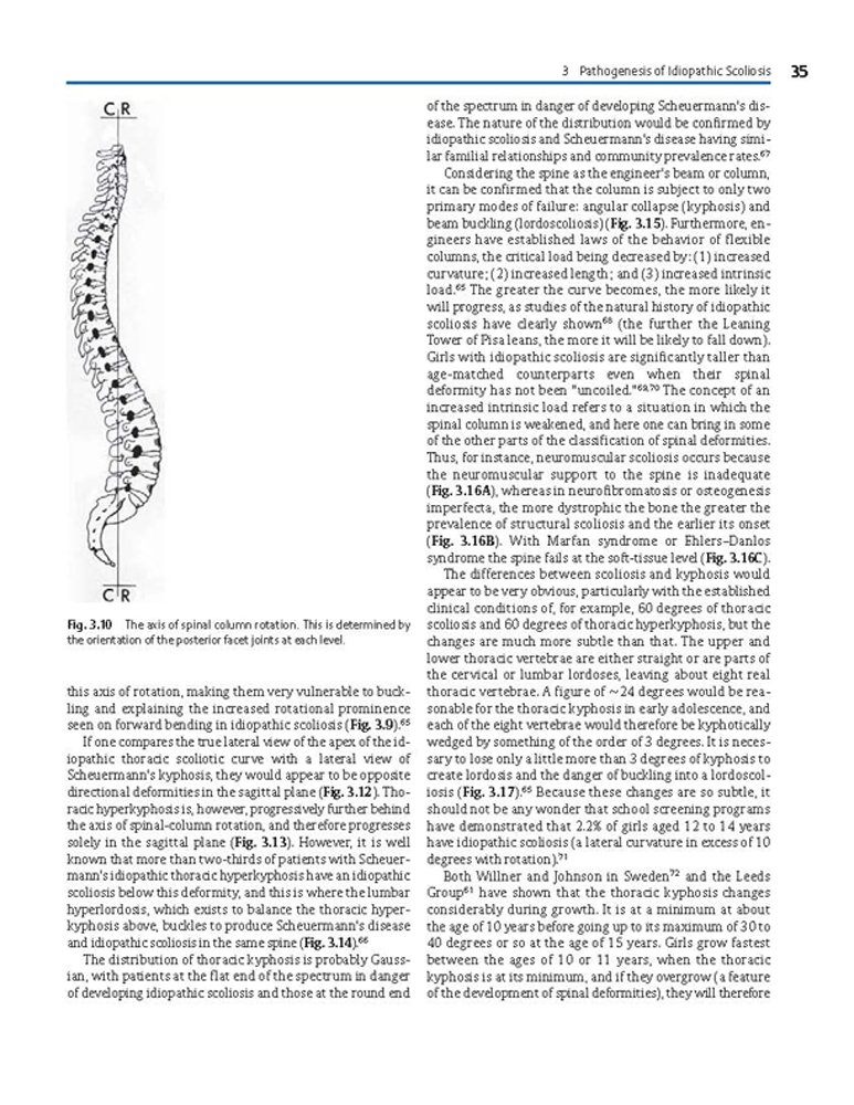 Idiopathic Scoliosis Treatment Guide - Harms Study Group Recommendations for Spinal Correction & Pain Relief | For Doctors, Physical Therapists & Patients