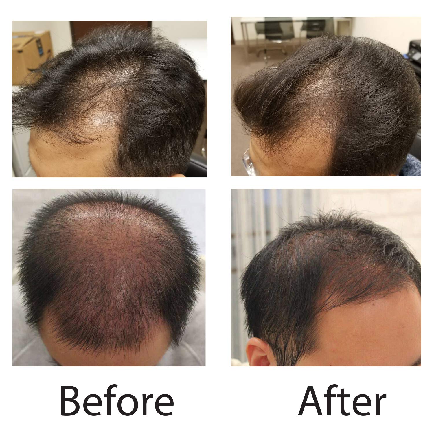 Hair Growth Cap with 81 Diodes - Laser Hair Loss Treatment for Men & Women - Hair Restoration Therapy Device for Thicker, Healthier Hair - Perfect for Home Use and Salon Treatments