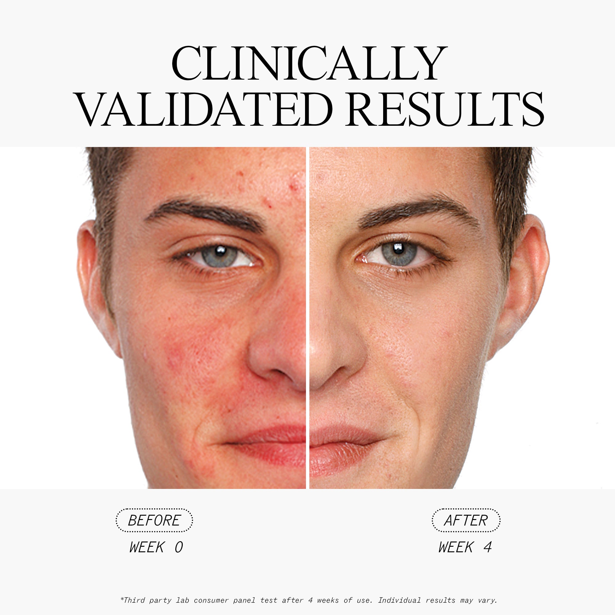 Acne SOS Kit with Salicylic Acid - Clear Skin Treatment for Face & Body | Perfect for Teen & Adult Acne Care at Home