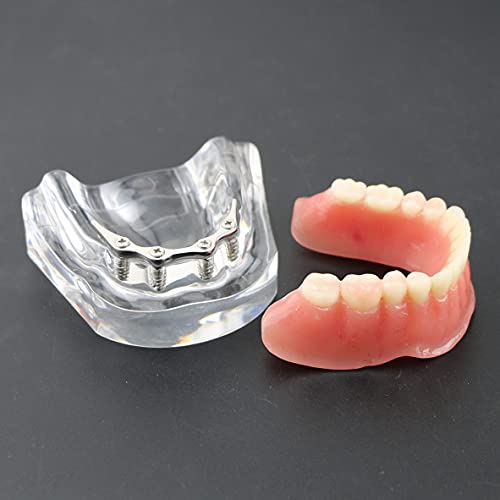 Dental Implant Teeth Model with Silver Screw Base - M6008 for Dental Teaching, Practice & Demonstration - Perfect for Dentists, Students & Dental Training Clinics