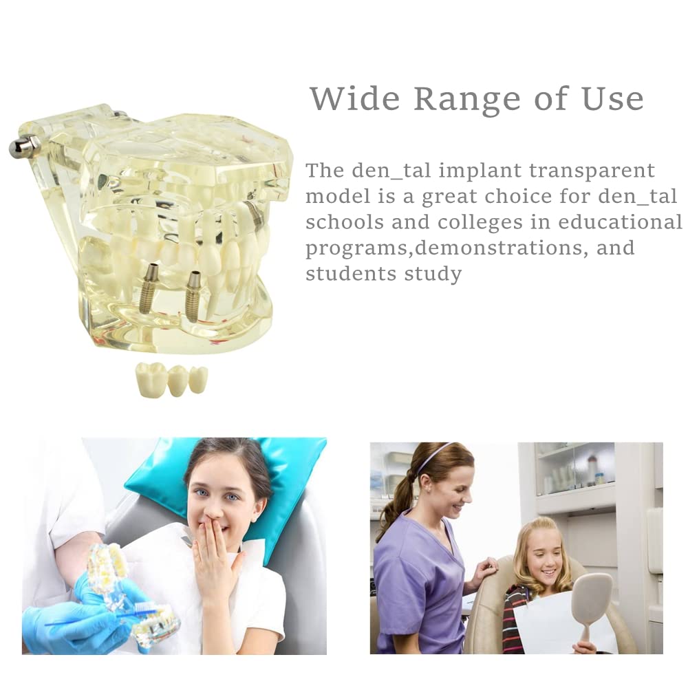 Dental Teeth Model - Transparent Implant Disease Removable Tooth Demonstration Kit for Dental Students & Professionals | Perfect for Classroom Teaching, Clinical Training & Patient Education