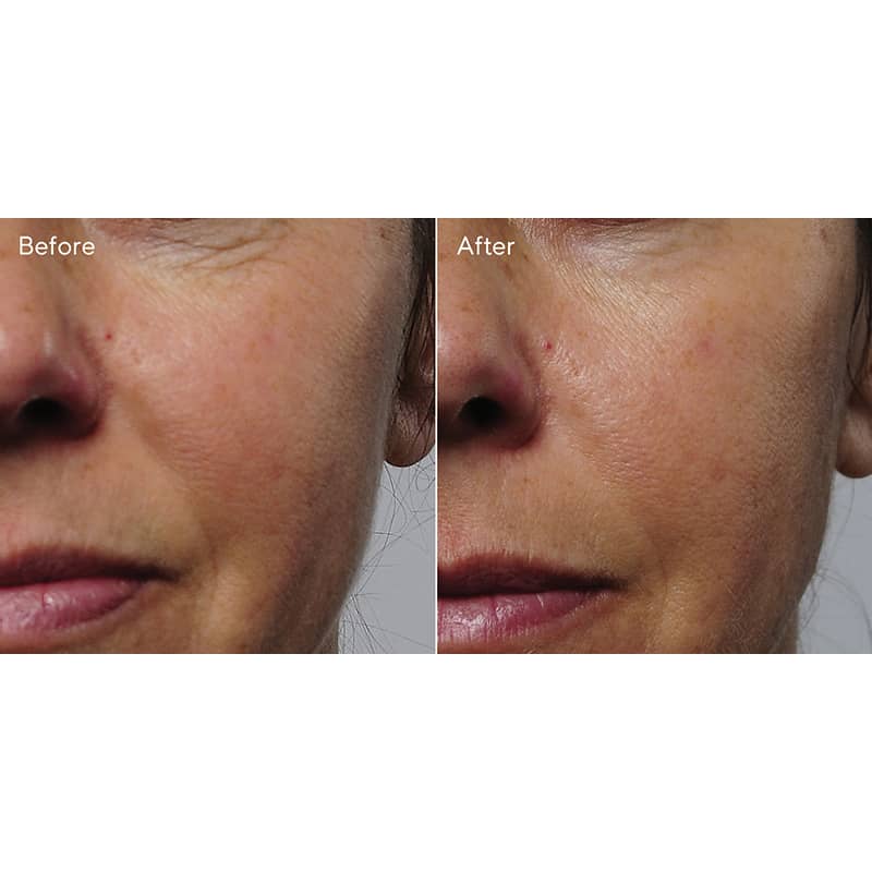 Murad Resurgence Rapid Collagen Infusion Face Serum - Anti-Aging & Hydrating Skincare Treatment for Wrinkles & Fine Lines - Perfect for Nighttime Routine & Daily Moisturizing