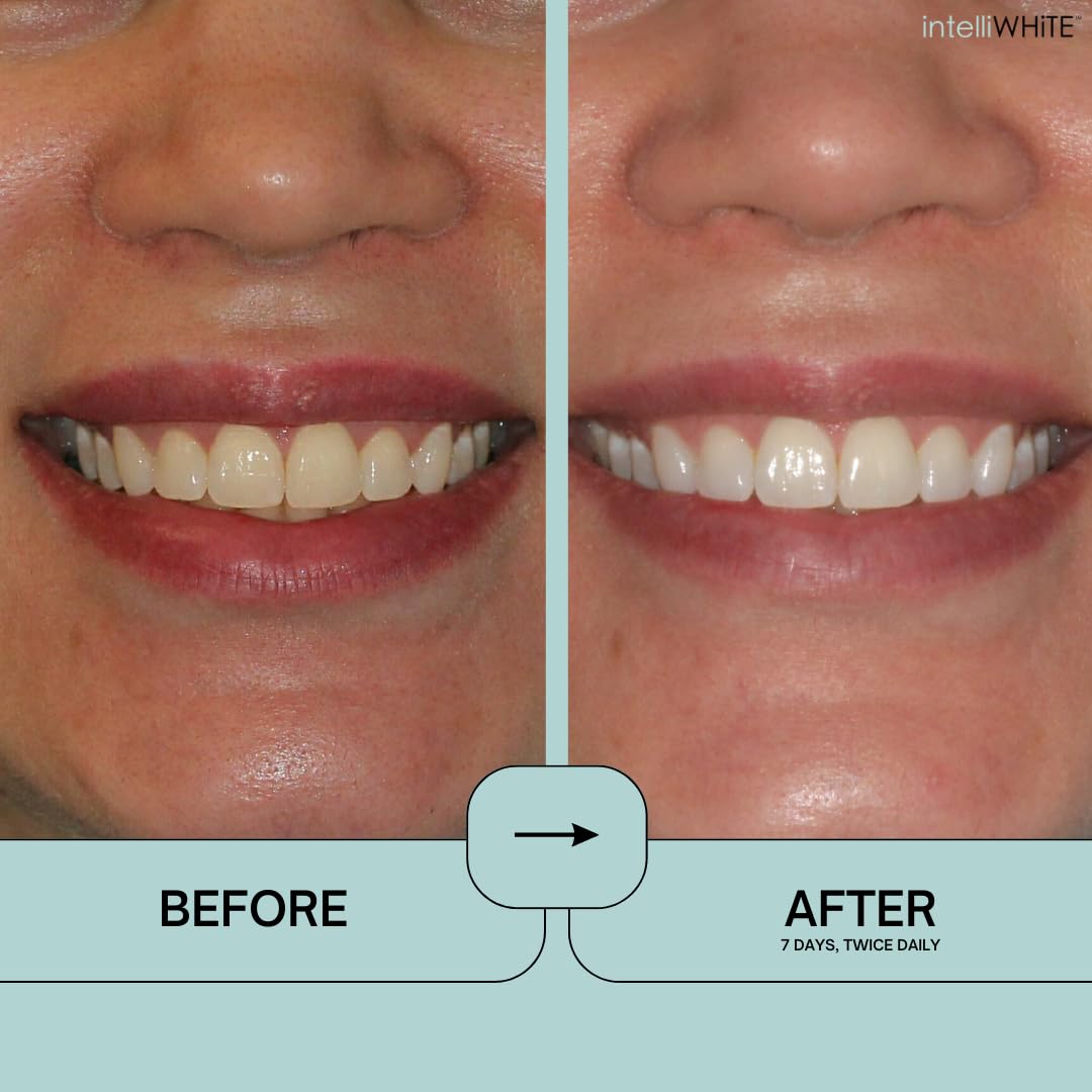 Prostrips Teeth Whitening Strips - 12 Shades Whiter, Enamel Safe & Remineralizing - 28 Gentle Strips with 97% No Sensitivity - Perfect for Daily Use & Special Occasions