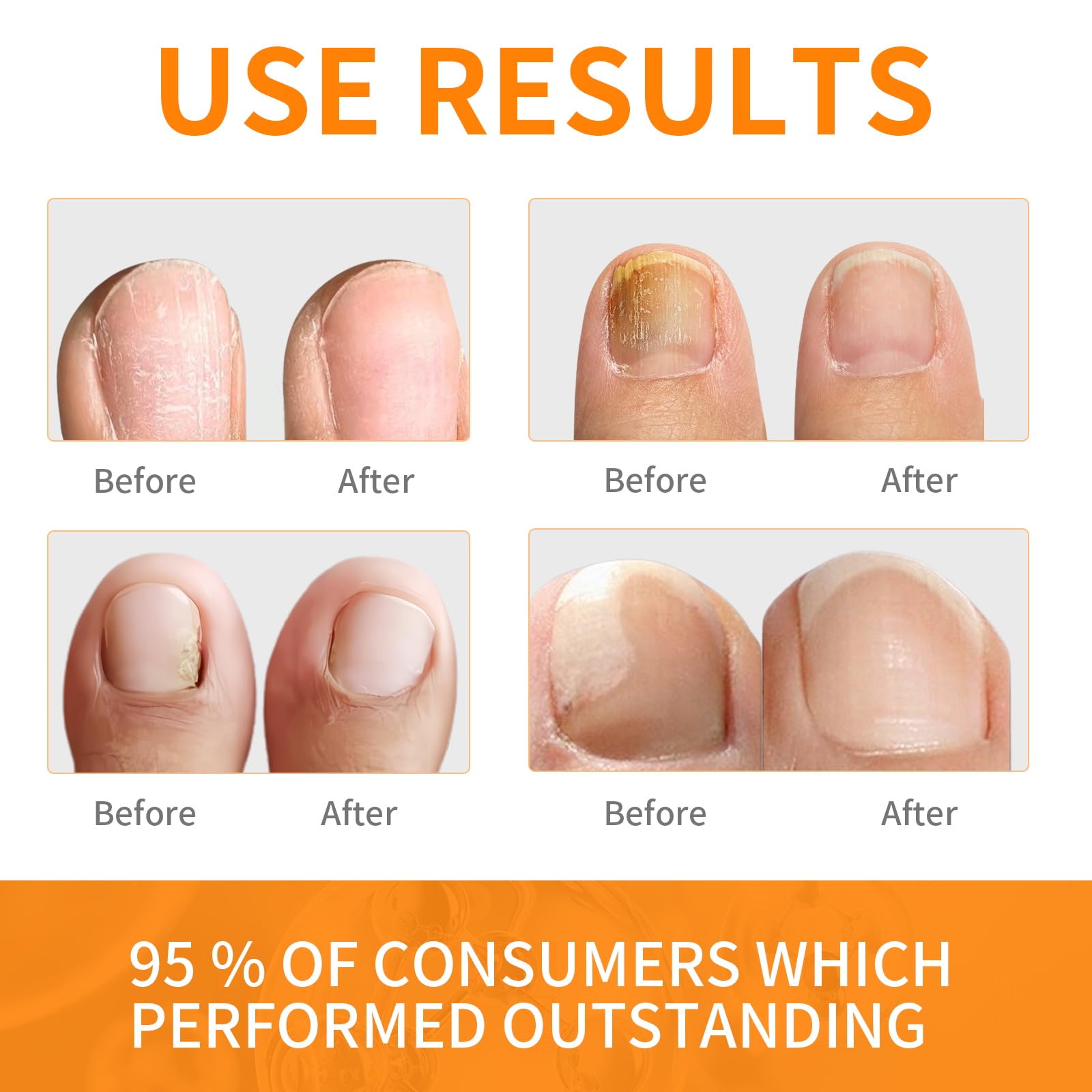 Extra Strength Toenail Fungus Treatment Fluid with Soft Brush Head - 30ML for Fast & Effective Nail Fungus Removal | Home Foot Care Solution for Athletes, Swimmers & Daily Use