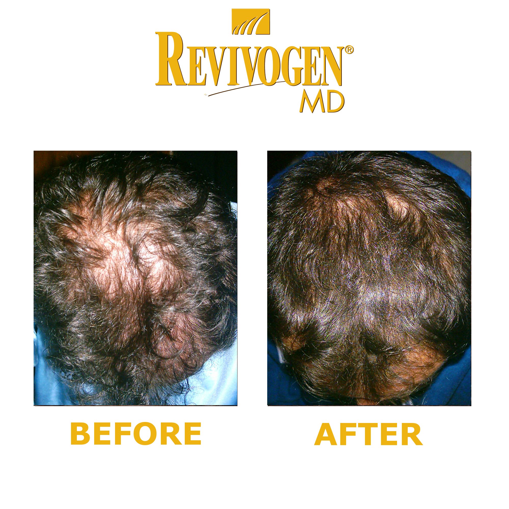 REVIVOGEN MD Scalp Therapy & Shampoo - Natural Hair Loss Treatment for Fine & Thinning Hair | DHT Blocker for Men & Women | Daily Use for Thicker, Healthier Hair Growth