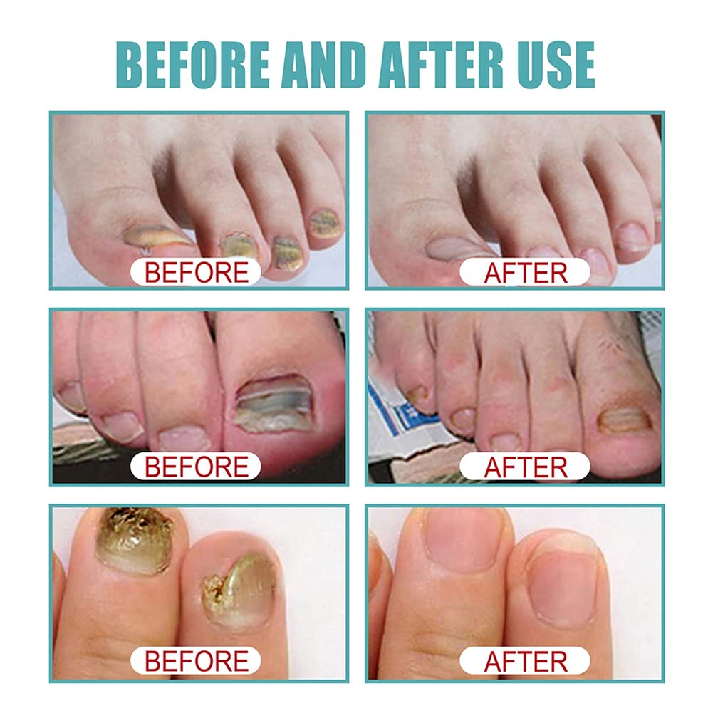 Extra Strong Nail Fungus Treatment - Repair Damaged Toenails for Men & Women - Perfect for Athletes & Daily Use