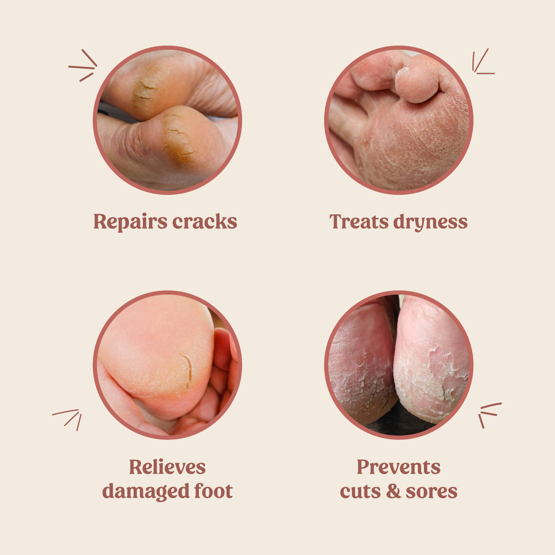 Best Foot Cream for Cracked Heels - Intensive Moisturizing Treatment for Dry, Rough Feet - Perfect for Daily Use at Home, Spa & Travel