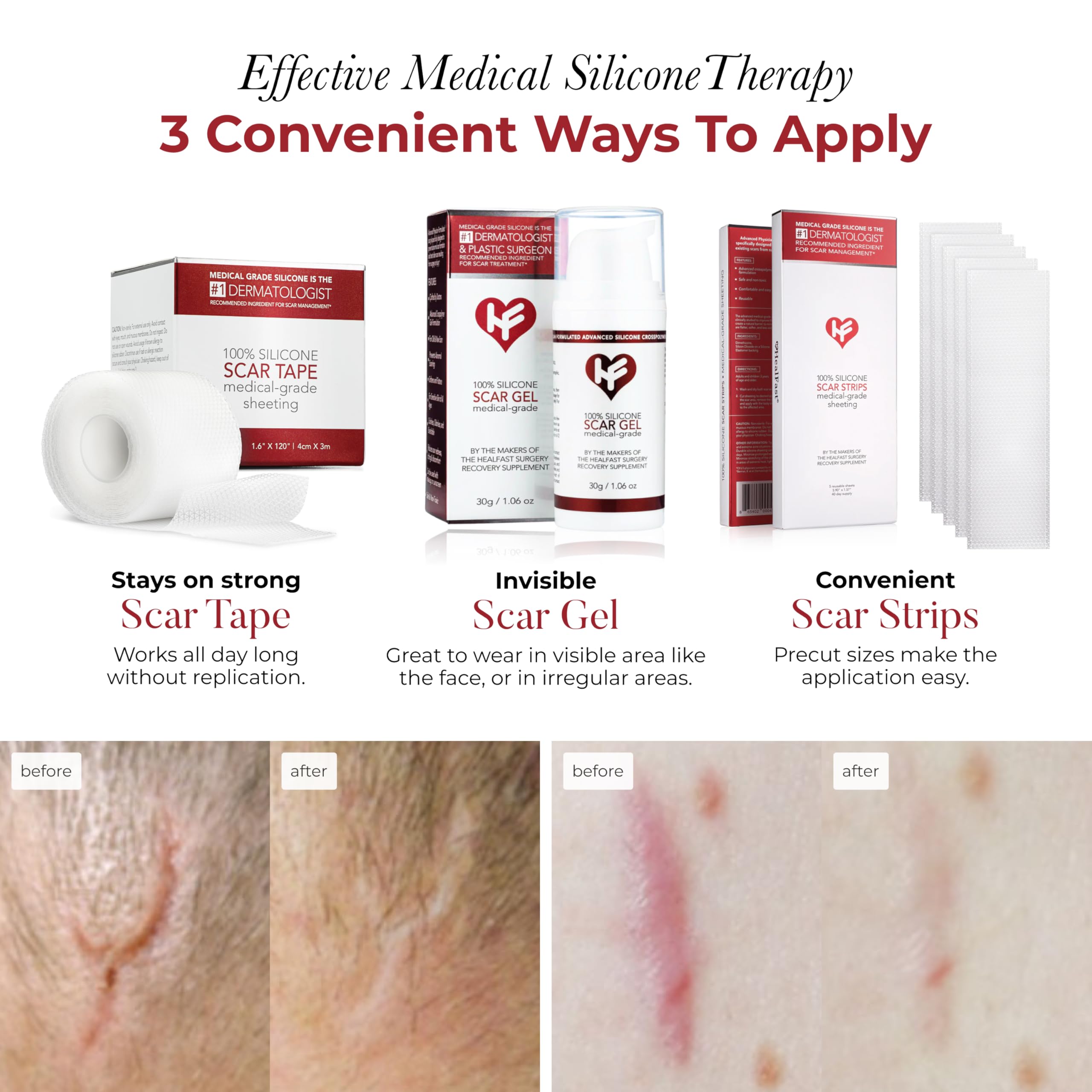 Physician Formulated Silicone Scar Sheets - Medical Grade Scar Tape for Surgery, C-Section, Keloids & Hypertrophic Scars - Reusable Scar Removal Patches for Post-Surgery Recovery & Skin Repair - Perfect for Daily Wear & Fading Old Scars