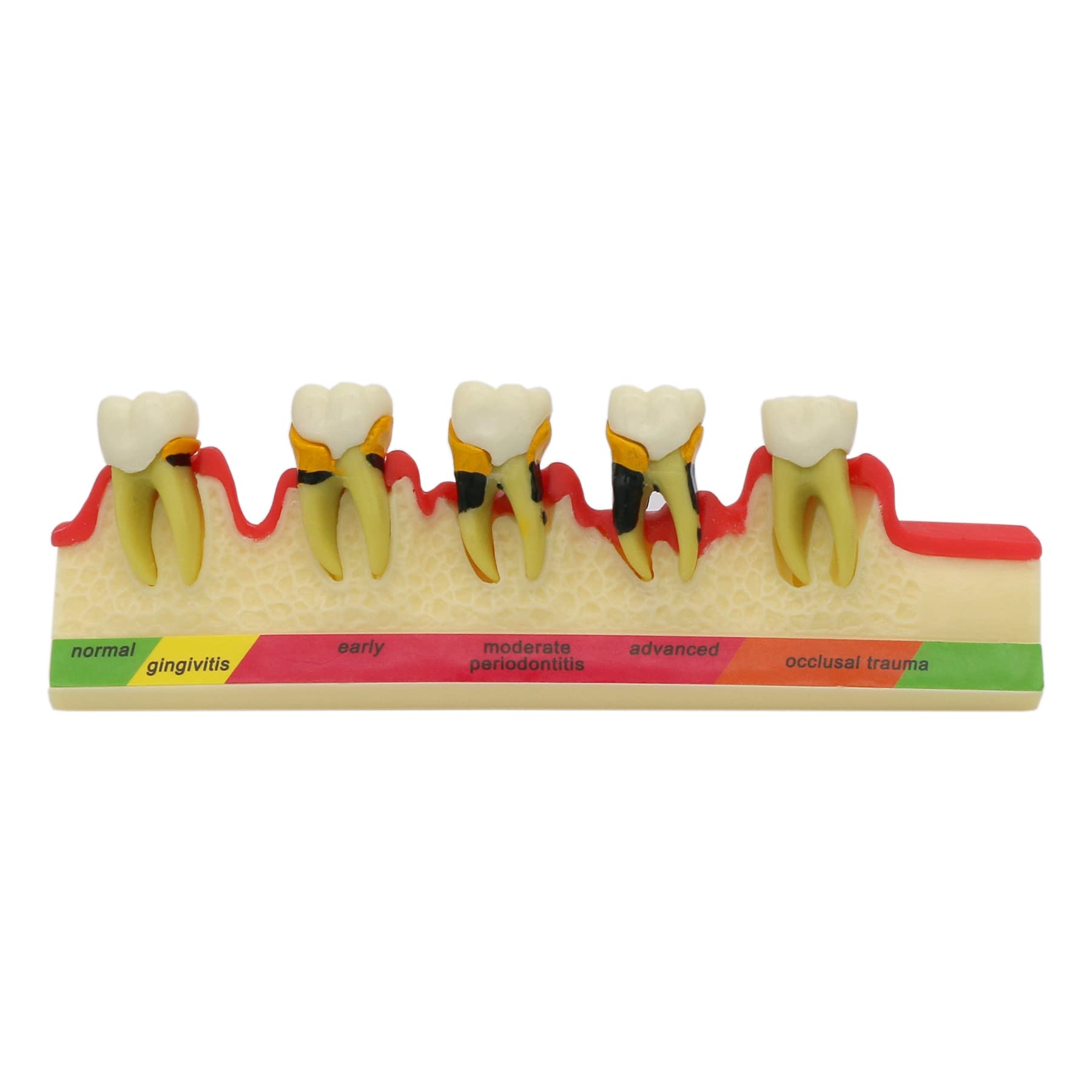 5-Stage Periodontal Disease Typodont Teeth Model - Dental Teaching & Study Demo for Lab Training (4010) | Perfect for Dental Students, Hygienists & Educators