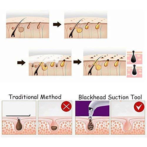 KanakMall 3-Level USB Charging T-Zone Pore Cleanser - Blackhead & Acne Removal Tool for Face & Nose - Perfect for Daily Skincare & Spa Treatments