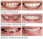 Non-Porous Silicone Artificial Braces for Teeth Whitening - Upper & Lower Dental Prostheses (2pcs) - Perfect for Cosplay, Halloween Costumes & Dental Practice