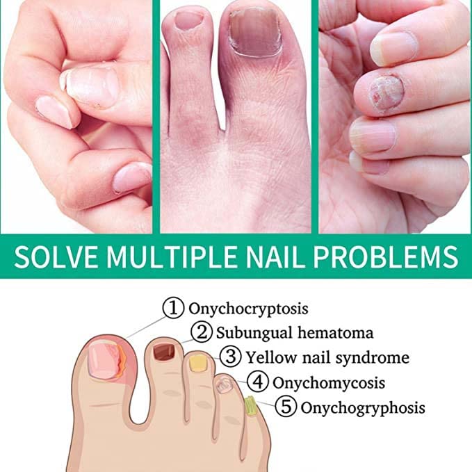 Kerassentials Toenail Fungal Treatment Oil - Extra Strong Foot & Nail Repair Kit for Fungus Relief | Athlete's Foot Care, Nail Restoration for Healthy Toes