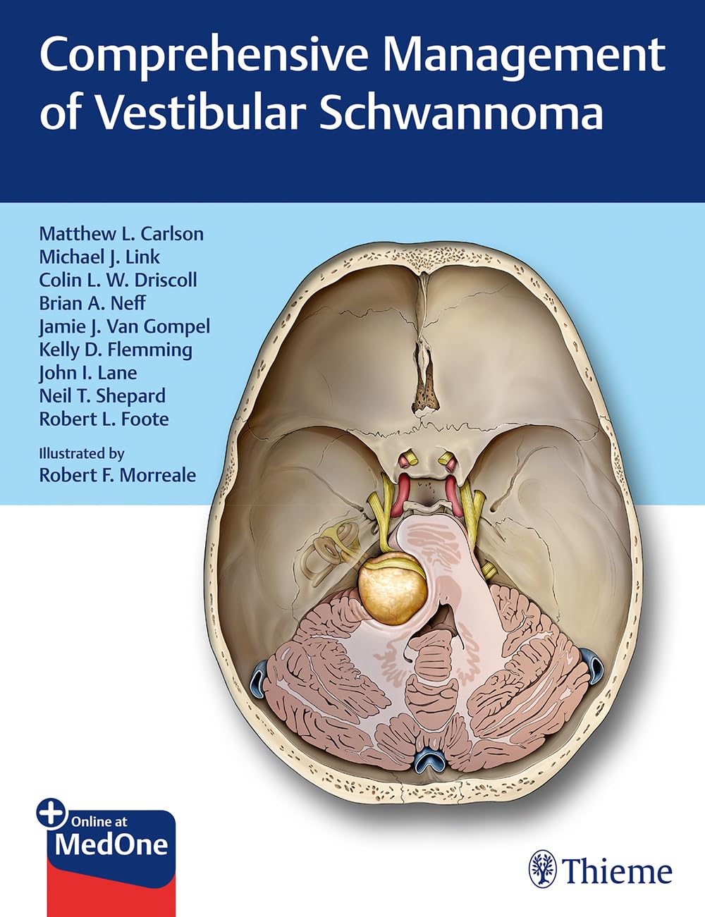 Vestibular Schwannoma Treatment & Management Guide - Symptoms, Surgery & Recovery for Acoustic Neuroma Patients | Home & Clinical Care