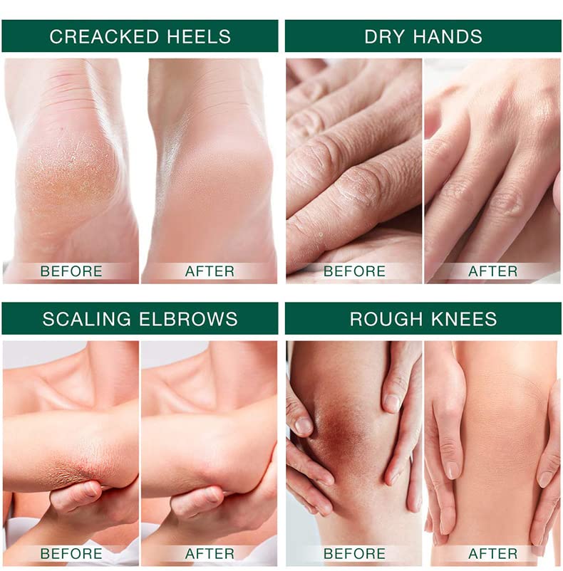 NP Urea Cream 42% with 2% Salicylic Acid - Maximum Strength Foot & Hand Moisturizer for Dry, Rough Skin - Callus Remover, Dead Skin Exfoliator - Deeply Nourishes & Softens - Ideal for Cracked Heels, Calluses & Rough Elbows