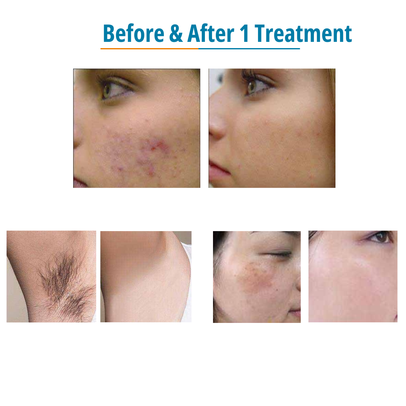 DermaLaze Delicate Pulsed Light System - IPL Hair Removal Device for Face & Body - At-Home Hair Removal Treatment for Women & Men - Smooth Skin Solution for Legs, Underarms, Bikini Line & More