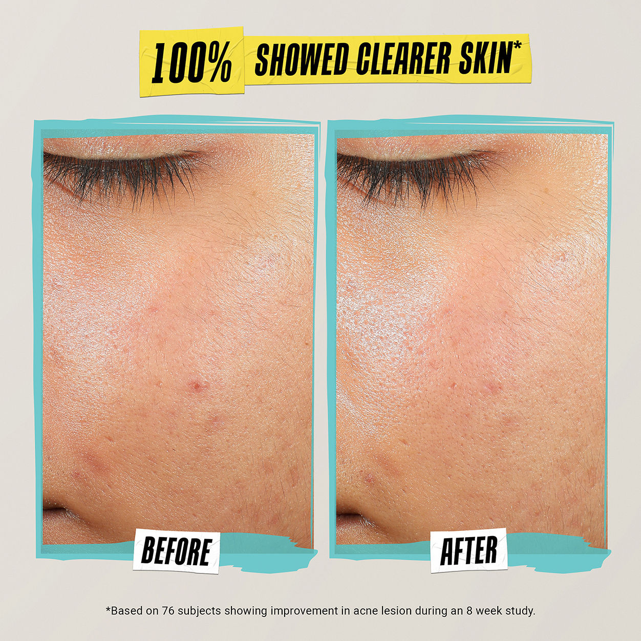 Best Acne Treatment Lotion for Clear Skin - Expert Formula to Prevent & Treat Breakouts | Perfect for Daily Skincare & Acne-Prone Skin