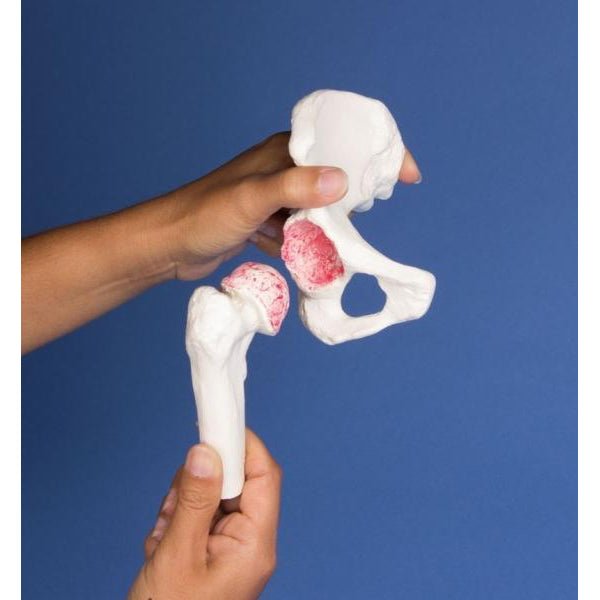 High-Quality Hip Implant Model - Medical Training & Surgical Demonstration Tool for Orthopedic Surgeons & Students