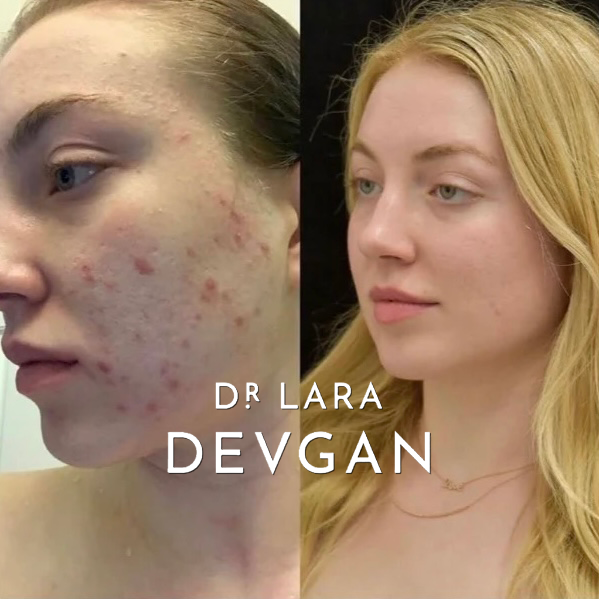 Dr. Devgan Advanced Lauric Acid Facial Cleanser - Gentle Foaming Face Wash for Acne-Prone & Sensitive Skin | Perfect for Morning & Night Skincare Routine