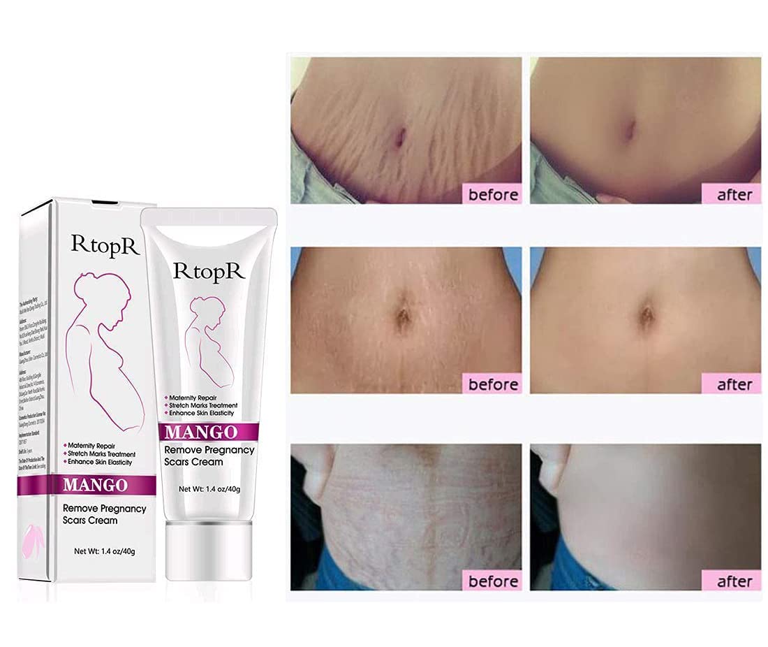 RtopR Mango Stretch Marks & Scar Removal Cream for Pregnancy - Best Body Moisturizer for Smooth Skin - 80g - Perfect for Postpartum Care & Skin Repair