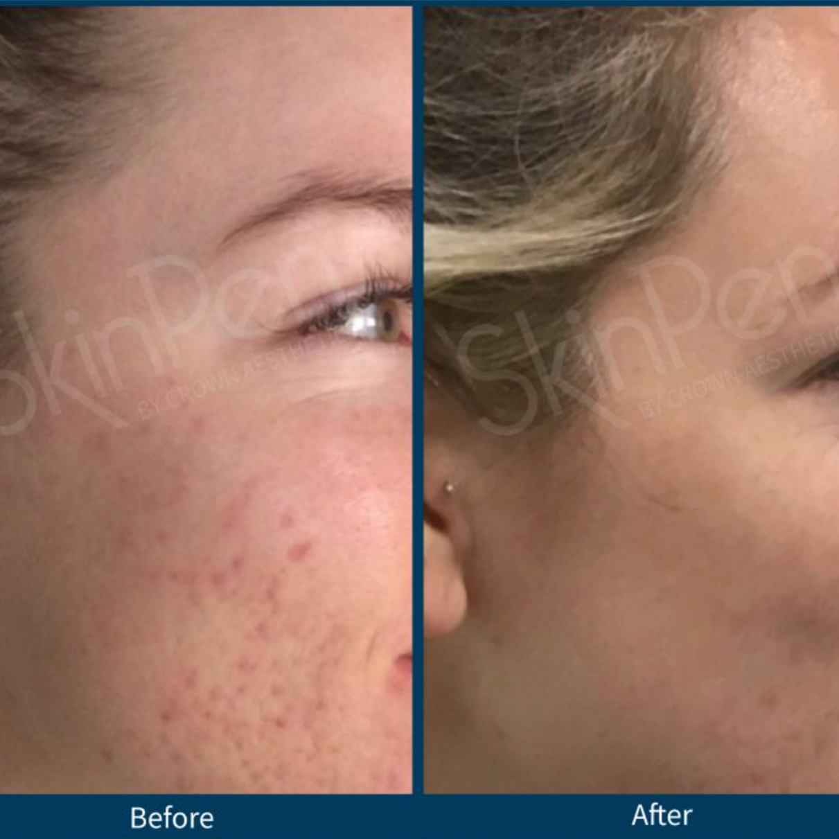 SkinPen® Microneedling Device for Face - Professional At-Home Collagen Induction Therapy | Anti-Aging & Skin Rejuvenation Treatment | Perfect for Wrinkles, Acne Scars & Uneven Skin Tone