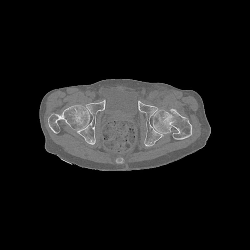 High-Quality Femoral Neck Fracture Pelvis Phantom for CT Scan & X-Ray Training - Perfect for Medical Education & Radiology Practice