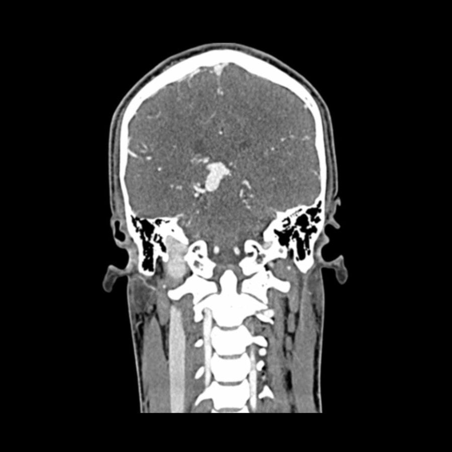 Head and Neck CTA Phantom AVM for CT Scan & X-Ray Training - Medical Imaging Practice, Radiology Education, and Diagnostic Testing