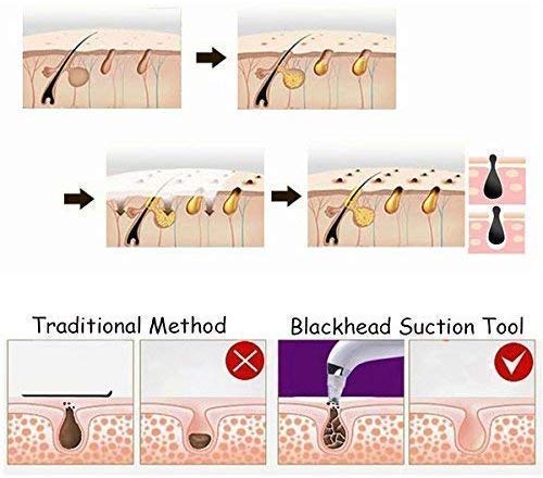 Divik Acne Pore Cleaner Vacuum - Blackhead Remover Kit for Women & Men - Perfect for Daily Facial Care