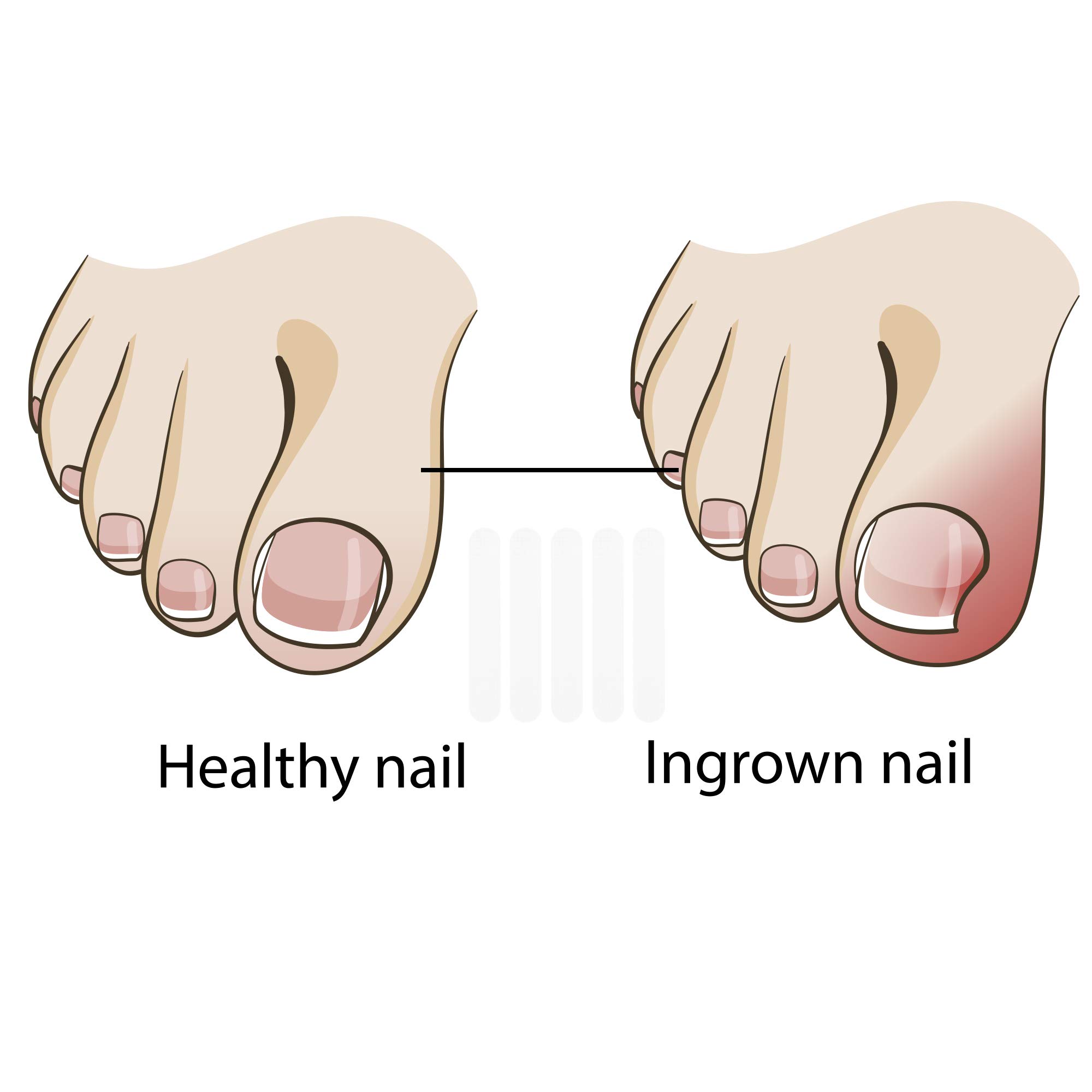 Uspeedy 50pcs Ingrown Toenail Corrector Strips - Straightening Clips for Curved & Thick Toenails | Pain Relief for Ingrown Toenails & Paronychia | Pedicure Tool for Home & Professional Use | Perfect for Athletes, Runners & Daily Foot Care