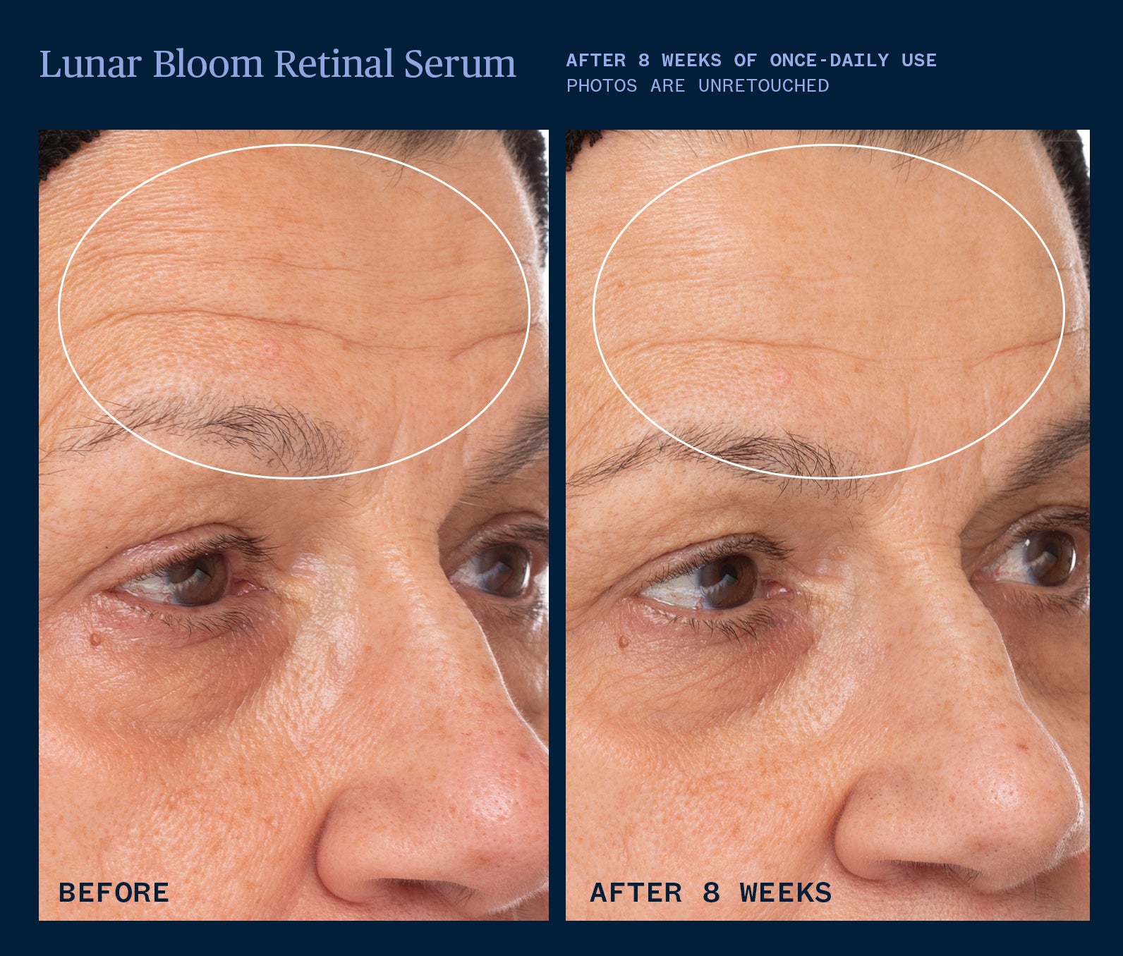 Lunar Bloom Retinal Serum for Wrinkles & Anti-Aging | Dark Spot Corrector & Night Repair Treatment | Perfect for Dry, Sensitive Skin & Evening Skincare Routine
