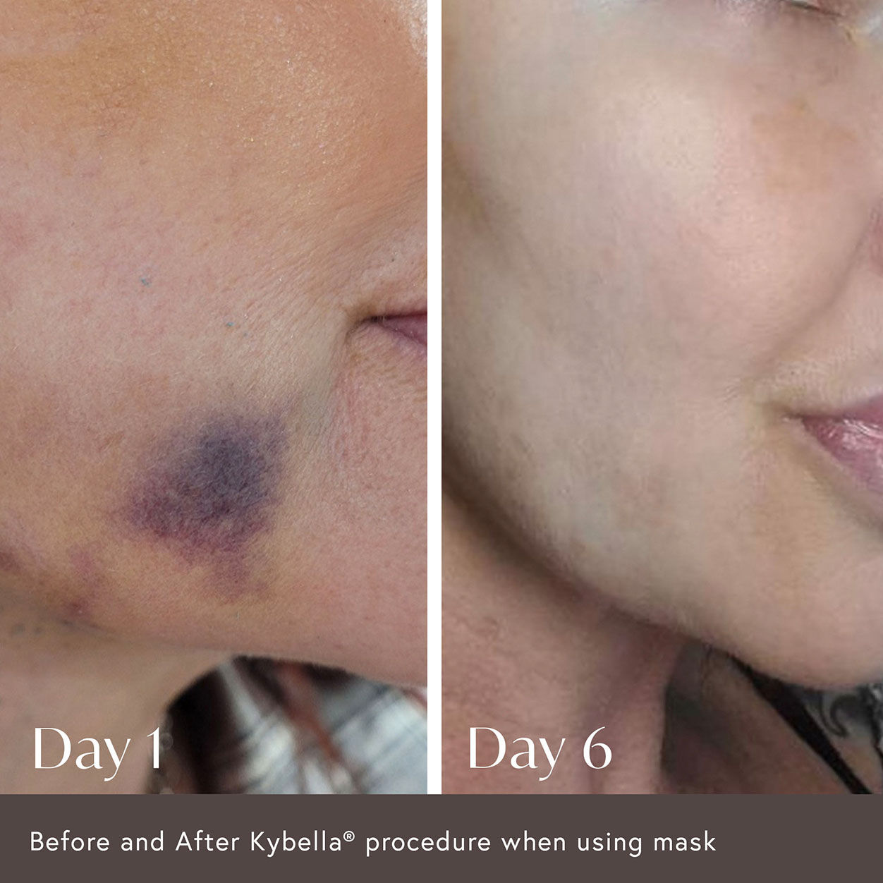 Ciao For Now Post Injection Care Mask - Hydrating & Soothing Facial Sheet for After Botox, Fillers & Cosmetic Procedures - Perfect for Post-Treatment Recovery & Skin Rejuvenation