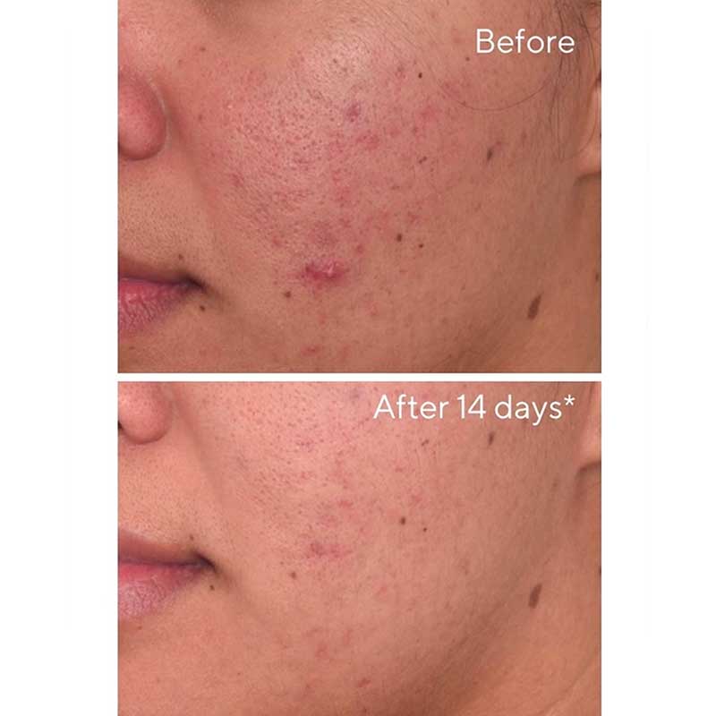 Murad Environmental Shield Rapid Dark Spot Correcting Serum - Brightening Face Treatment for Hyperpigmentation & Age Spots - Perfect for Daily Skincare Routine & Nighttime Use