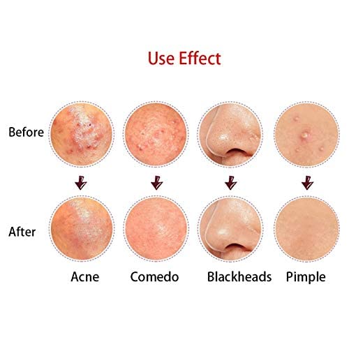 MAPPERZ Blackhead & Acne Removal Kit - 4 Pc Professional Comedone Extractor Tools for Whiteheads & Pimples on Nose & Face (Includes Storage Case) - Perfect for At-Home Skincare Routine & Spa Treatments
