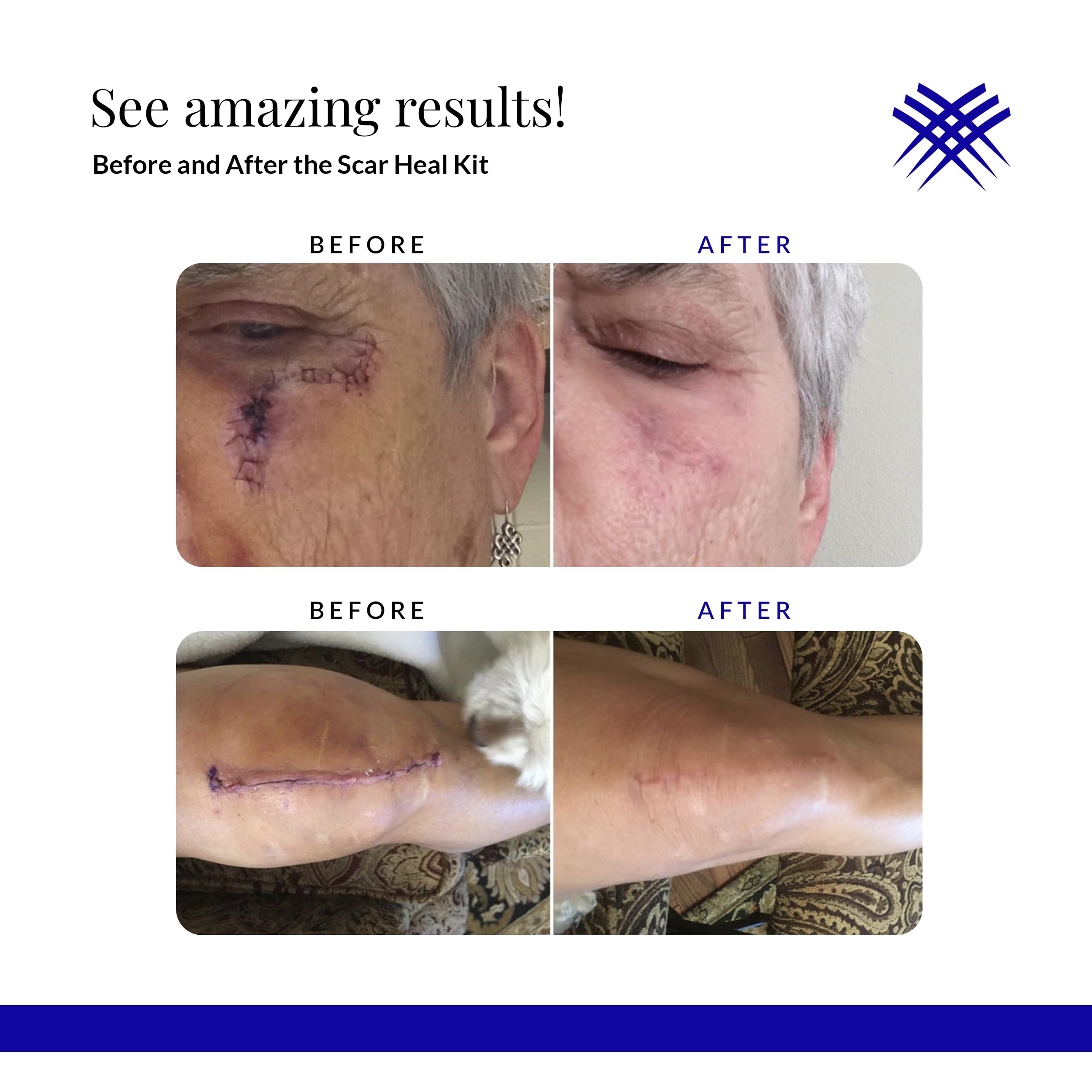 Rejuvaskin Scar Heal Kit for Large Surgical Scars - Soften, Flatten & Reduce Scar Appearance with Silicone Sheeting, RejuvaSil Gel & Medical Tape (4
