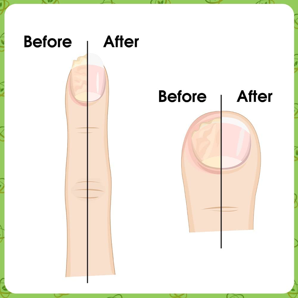 VYTALIVING BioClear Nail Doctor - Effective Ingrown Toenail & Fungal Nail Treatment | Fast-Acting Toenail Repair Solution | 15ml | Perfect for Athletes, Runners & Pedicure Care