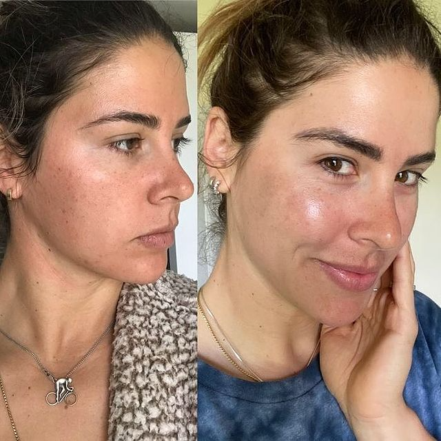 Dr. Devgan Hyaluronic Niacin Panthenol Serum - Hydrating Anti-Aging Face Serum with Hyaluronic Acid & Niacinamide - Perfect for Dry Skin & Fine Lines Reduction - Day & Night Skincare Routine