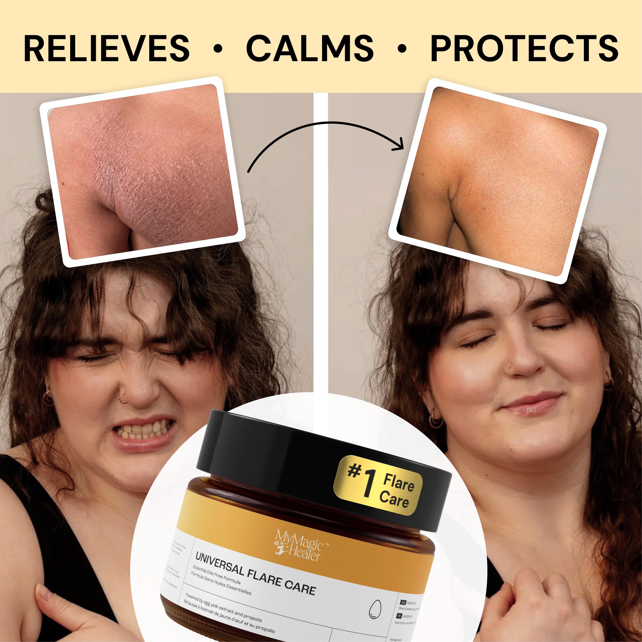 Universal Flare Care - Essential Oil Free Skin Relief for Eczema, Dermatitis, Psoriasis, Rashes & Baby Skin Issues | Propolis & Egg Yolk Formula | Soothes Hidradenitis, Chafing, Sores & Wounds | 1oz | Perfect for Daily Skincare & Sensitive Skin Care Routine