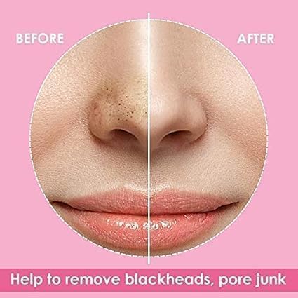 6-in-1 Blackhead & Whitehead Remover Tool - Professional Pimple Extractor, Acne Treatment & Pore Vacuum Cleaner for Men & Women (White/Black) | Perfect for Home Skincare & Facial Spa Treatment