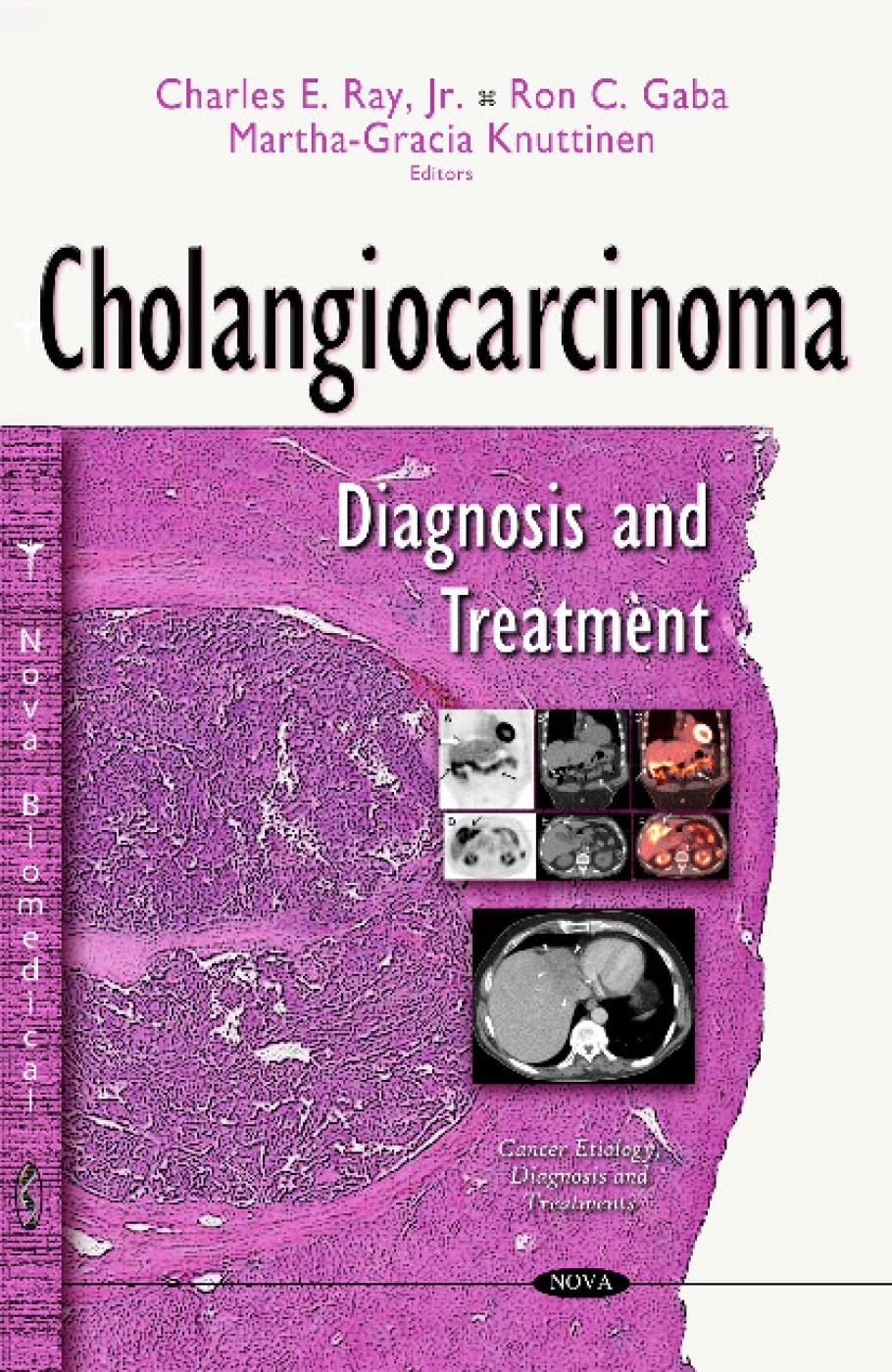 Cholangiocarcinoma: Diagnosis, Treatment & Latest Research | Cancer Etiology, Symptoms & Therapies | For Patients & Healthcare Professionals