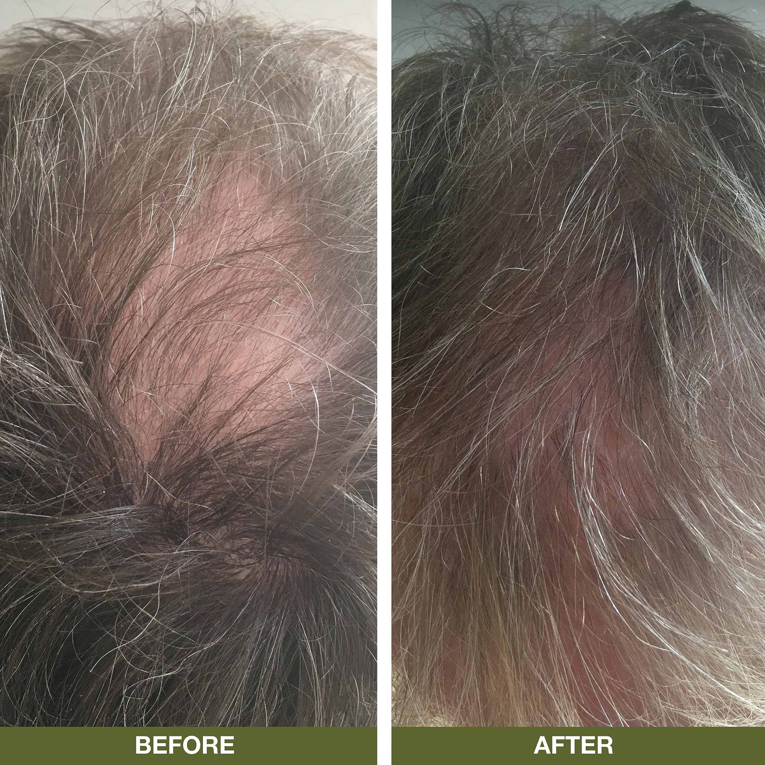 **Anti Hair Loss Shampoo 200ml with Lemon Extract – Best for Thinning Hair & Hair Growth – Ideal for Men & Women with Slow Hair Growth – Perfect for Daily Use & Scalp Care**