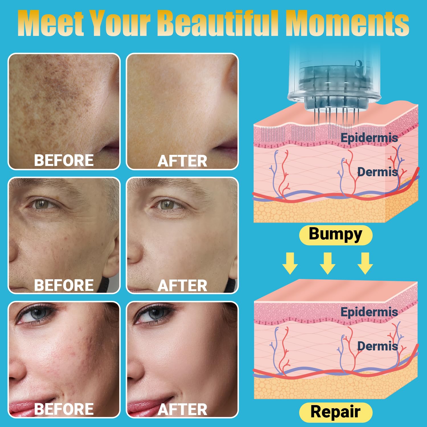 Professional Microneedle Roller Kit for Face & Beard - At-Home Derma Roller for Skin Rejuvenation & Hair Growth | Perfect for Anti-Aging, Acne Scars & Skincare Routine
