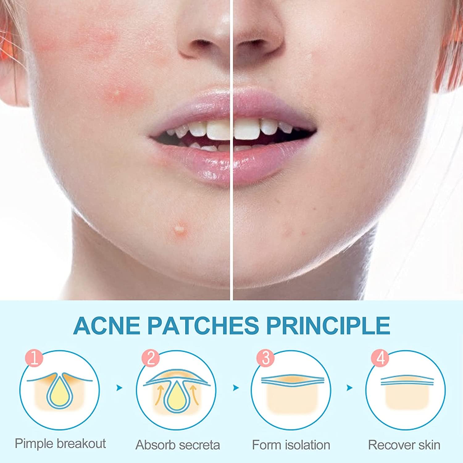 Tristar Beauty Miracle Acne and Pimple Cover Patches - 24 Count Invisible Spot Treatment for Face, Fast Healing, Oil Absorbing - Perfect for Overnight Use, Travel, and Daily Skincare Routine
